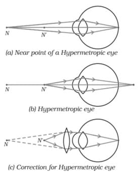 Diagram Showing Correction of Hypermetropia